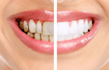 Как снять желтый налет с зубов?